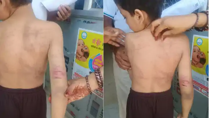निजी स्कूल के शिक्षक ने मासूम छात्र को बेरहमी से पीटा, पिता 