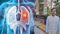 7 Minute Lung Cancer Immunotherapy Launched in India
