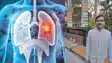 7 Minute Lung Cancer Immunotherapy Launched in India