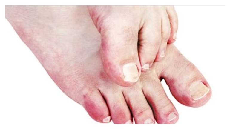 Foot care important in winter