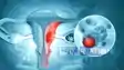 uterine cancer