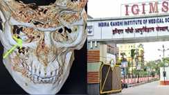 Patna News : आईजीआईएमएस में ‘आंख में दांत’ का डॉक्टर्स ने किया सफल ऑपरेशन, निदेशक सहित वरीय अधिकारियों ने की टीम की जमकर सराहना