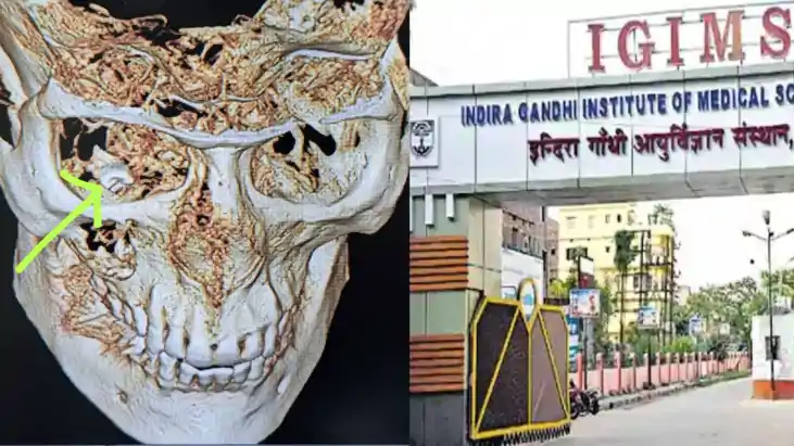 Patna News : आईजीआईएमएस में ‘आंख में दांत’ का डॉक्टर्स ने कि Patna News : आईजीआईएमएस में ‘आंख में दांत’ का डॉक्टर्स ने कि