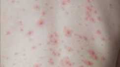 Chicken pox wreaks havoc in Patna