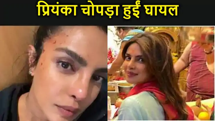 प्रियंका चोपड़ा  हुईं घायल, एक्ट्रेस ने दिखाए चोट के निशान, 