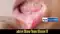 Oral Cancer Signs