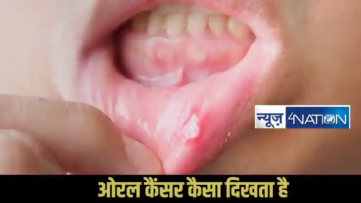 Oral Cancer Signs