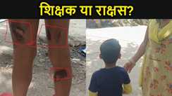 शिक्षक या राक्षस? पटना में टीचर बना हैवान,  6 और 8 साल के छात्र को गर्म चम्मच से दागा, स्कूल प्रशासन पर खड़े हो रहे सवाल
