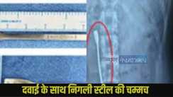 l young man accidentally swallowed an 8 cm steel spoon