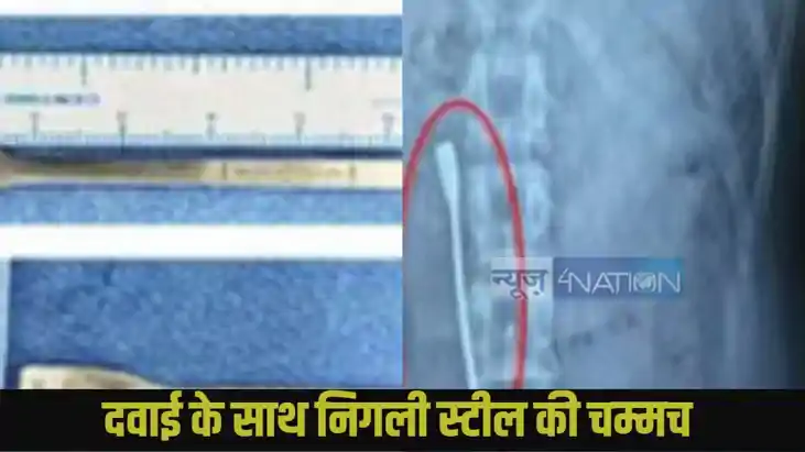 l young man accidentally swallowed an 8 cm steel spoon l young man accidentally swallowed an 8 cm steel spoon