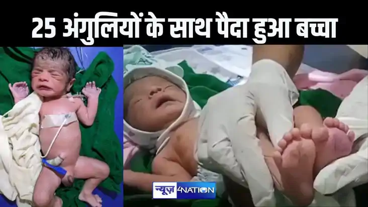 हाथ-पैर में है 25 अंगुलियां, नवजात के जन्म के बाद हर कोई हैर