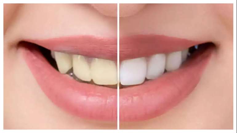 Teeth Whitening Tricks: अपने दांतों के पीलेपन से हैं परेशान, इन नुस्खों को अपनाकर करें वाइट 