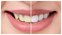 Teeth Whitening Tricks: अपने दातों के पीलेपन से हैं परेशान, इन नुस्खों को अपनाकर करें वाइट 