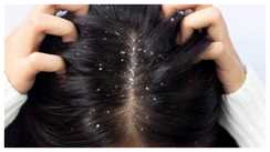 Dandruff Free Hair: रूसी से पाना है छुटकारा, तो इस तेलों का करें इस्तेमाल