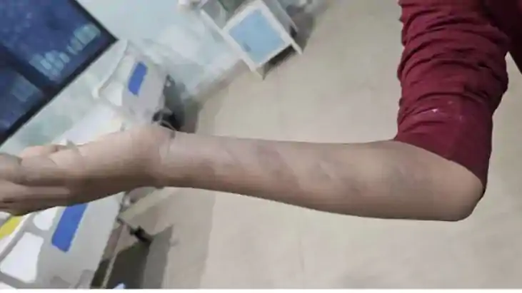 प्राइवेट स्कूल में शिक्षक ने छात्र को बेरहमी से पीटा, शरीर प