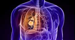  Lung Cancer