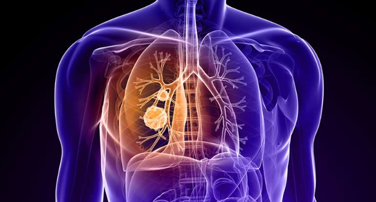  Lung Cancer