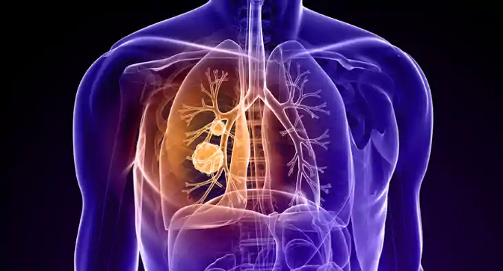  Lung Cancer