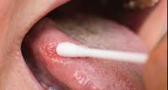 Oral Cancer