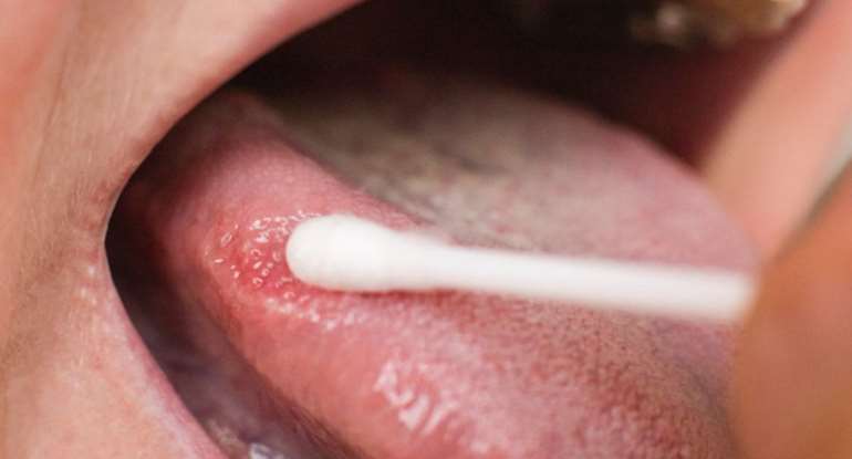 Oral Cancer